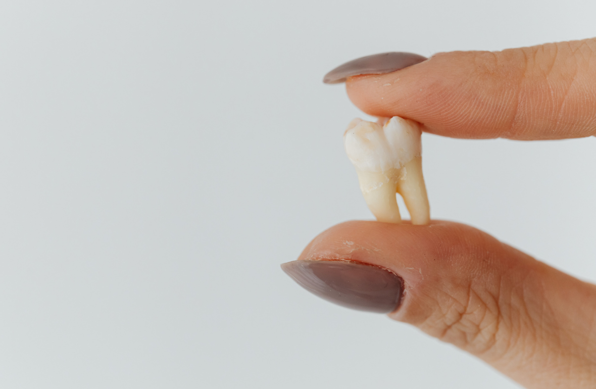 20’lik Diş Nedir ve Neden Çekilir