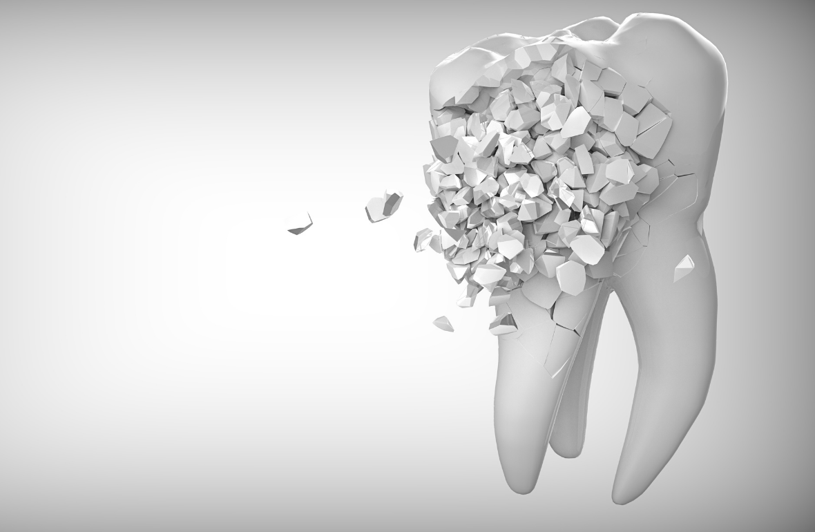 Diş Çürüğü Ağrı Yapmadan İlerler mi Sessiz Tehlikeler