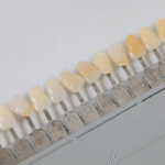 Diş Beyazlatma (Bleaching) Nedir