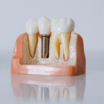 İmplant Tedavisi Ne Kadar Sürer