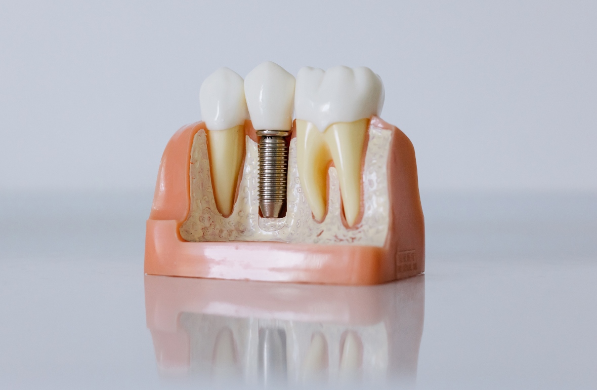 İmplant Tedavisi Ne Kadar Sürer