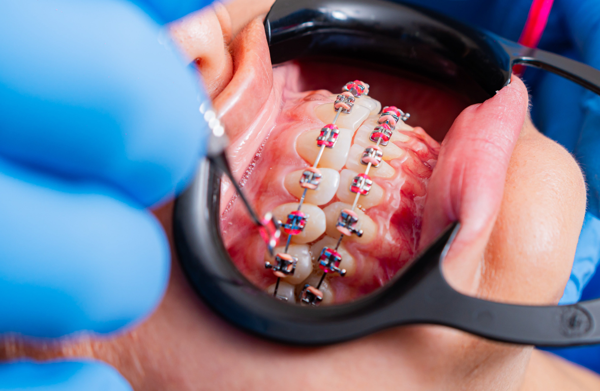 Ortodontik Tedavi Nedir? Sadece Diş Teli mi?
