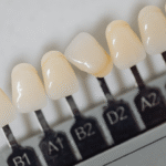 Zirkonyum Kaplama mı Porselen mi? Hangisi Daha İyi?