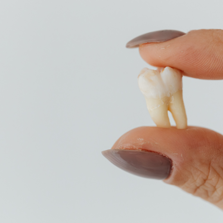 20’lik Diş Nedir ve Neden Çekilir