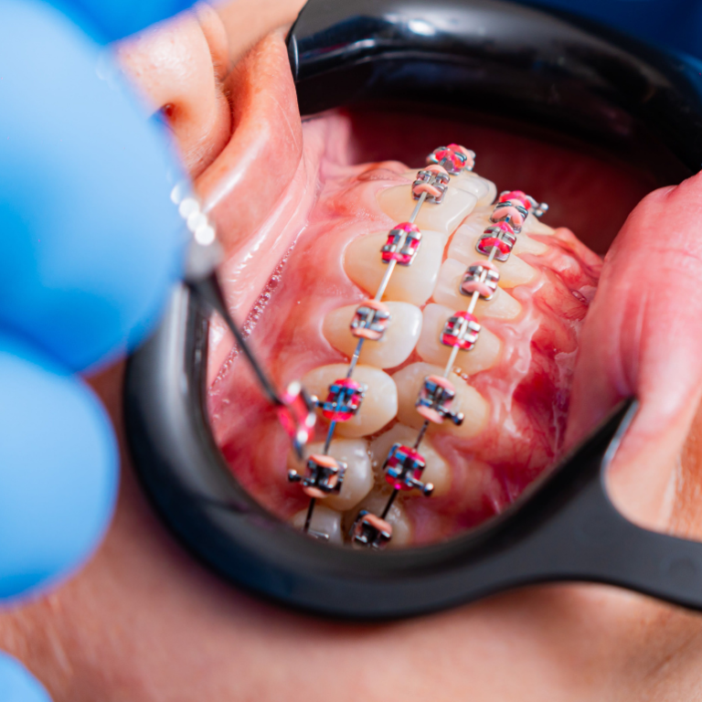 Ortodontik Tedavi Nedir? Sadece Diş Teli mi?