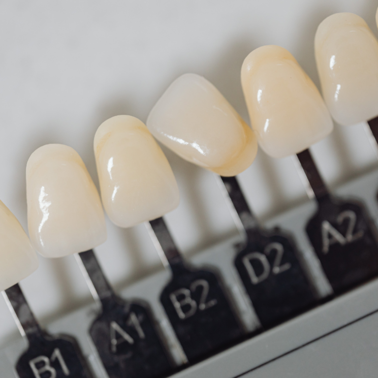 Zirkonyum Kaplama mı Porselen mi? Hangisi Daha İyi?